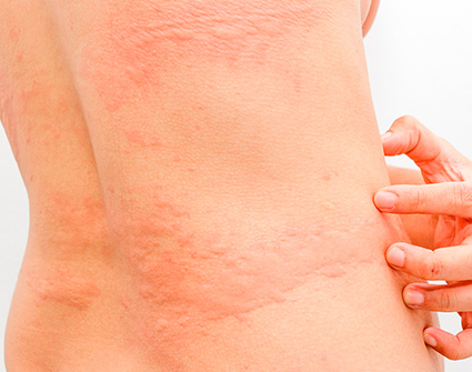Alergias de la piel